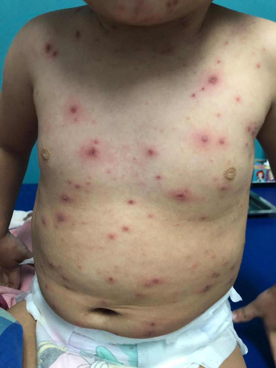 Los contagios de varicela en Quintana Roo aumentaron a 593 Los contagios de varicela en Quintana Roo aumentaron a 593