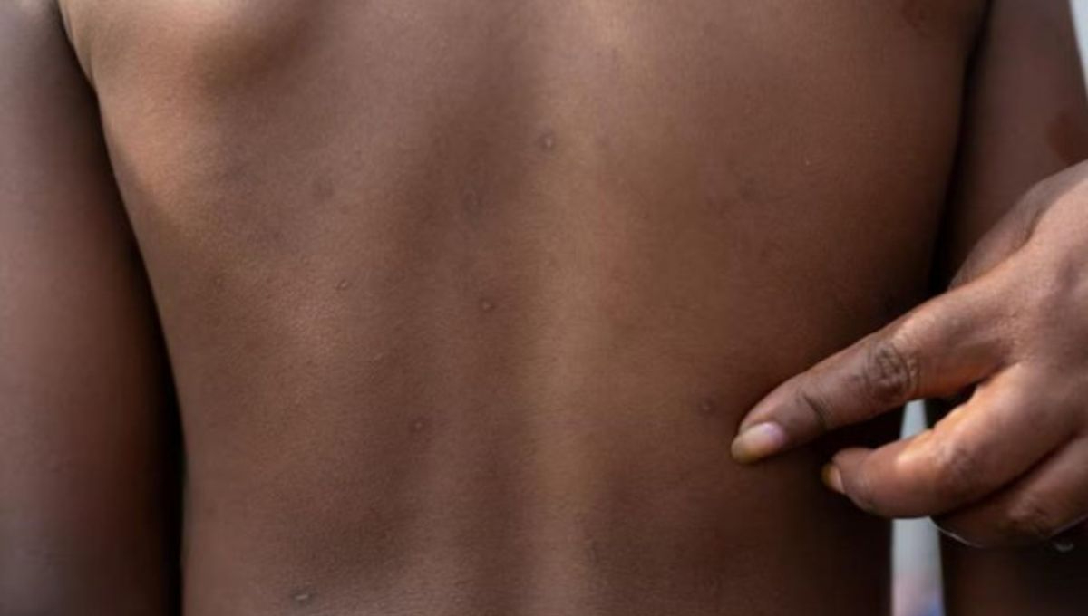 África pide emergencia de salud pública por brote de mpox