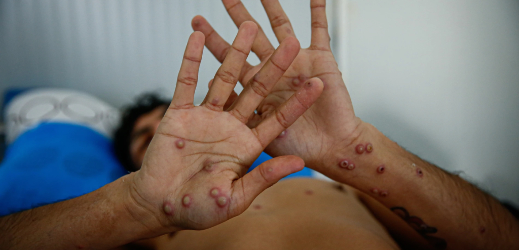 Yucatán suma cinco contagios por mpox durante el 2024