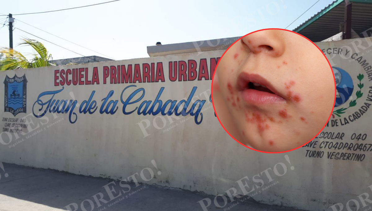 Brote del virus Coxsackie provoca alarma en la primaria Juan de la Cabada Vera, en Ciudad del Carmen.