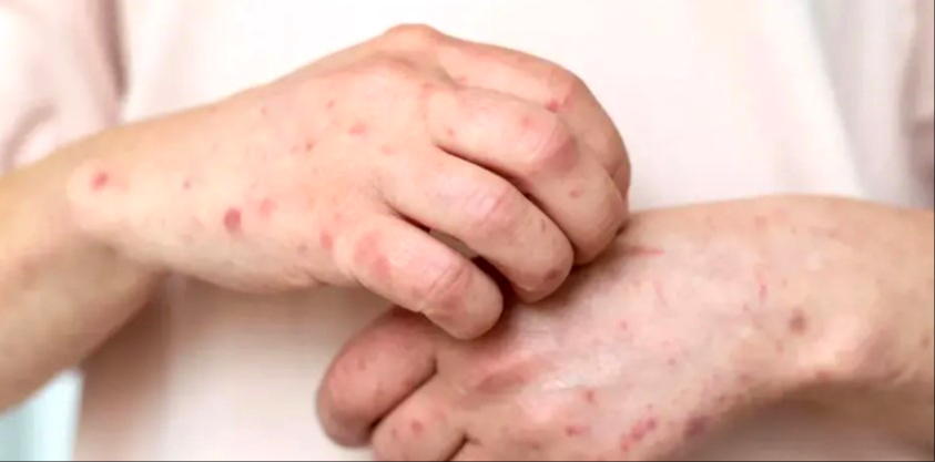 Los síntomas más frecuentes son fiebre, dolor de cabeza, cansancio y erupciones cutáneas en el cuerpo Los síntomas más frecuentes son fiebre, dolor de cabeza, cansancio y erupciones cutáneas en el cuerpo