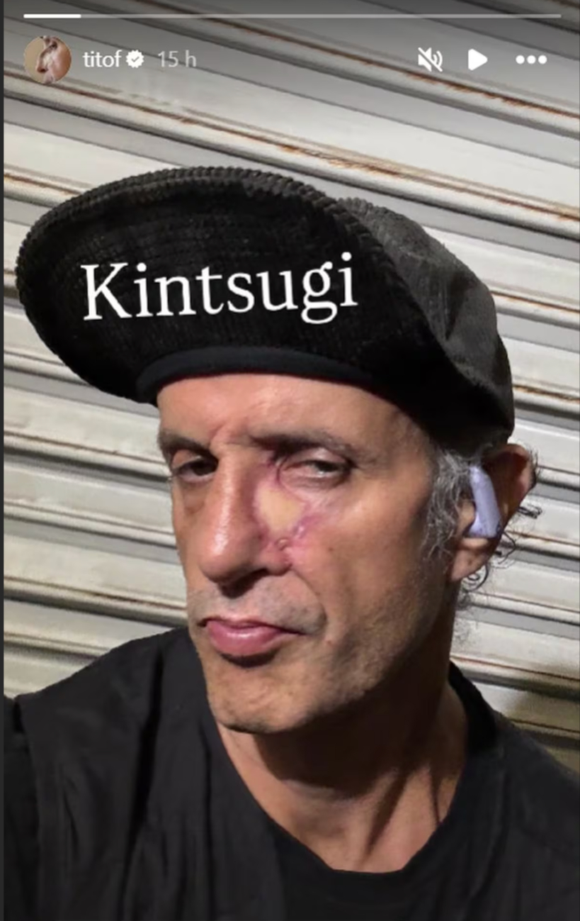 El artista a un año de la cirugía El artista a un año de la cirugía