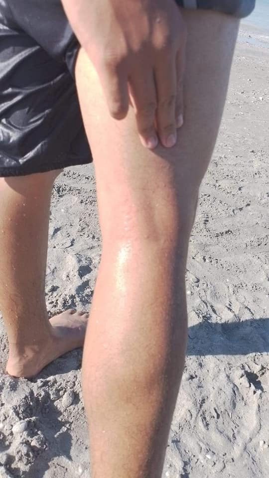 Esta criatura marina posee tentáculos venenosos que causan dolor intenso, enrojecimiento e hinchazón al contacto con la piel