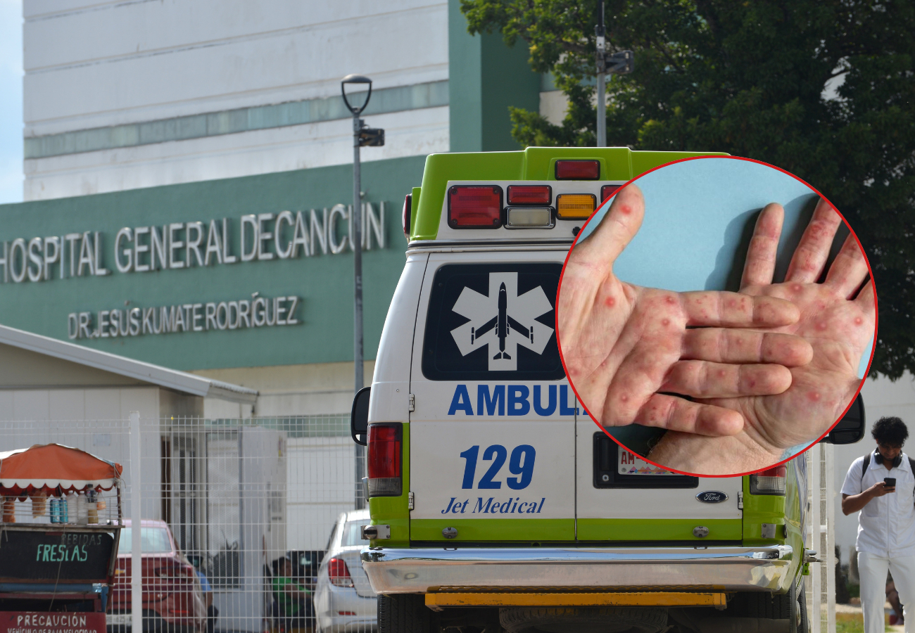 De acuerdo con reportes, todos los pacientes con lesiones en la piel son hombres; con mayor incidencia en la zona norte