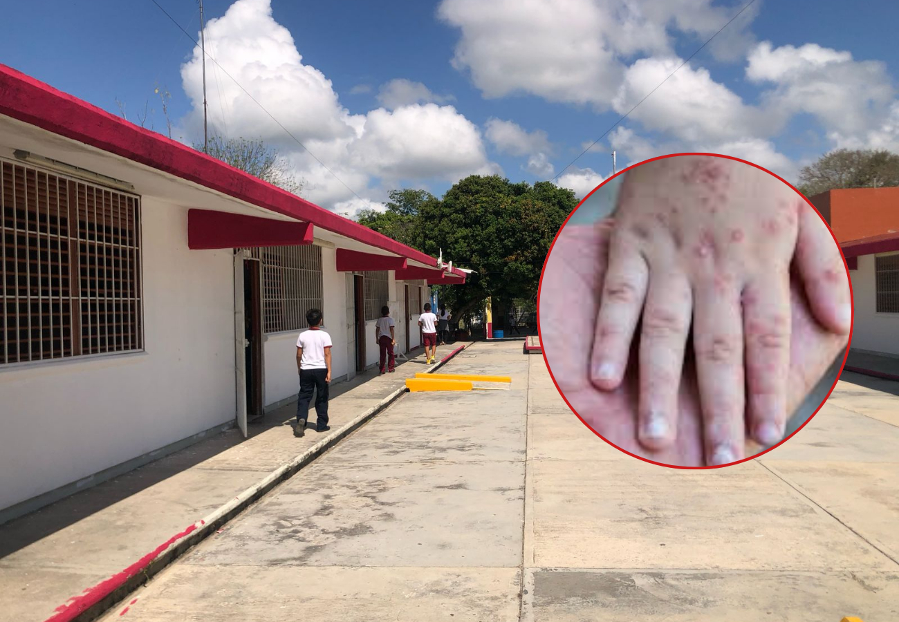 Cancelan clases en Calderitas por virus Coxsackie: Van 79 casos confirmados hasta ahora