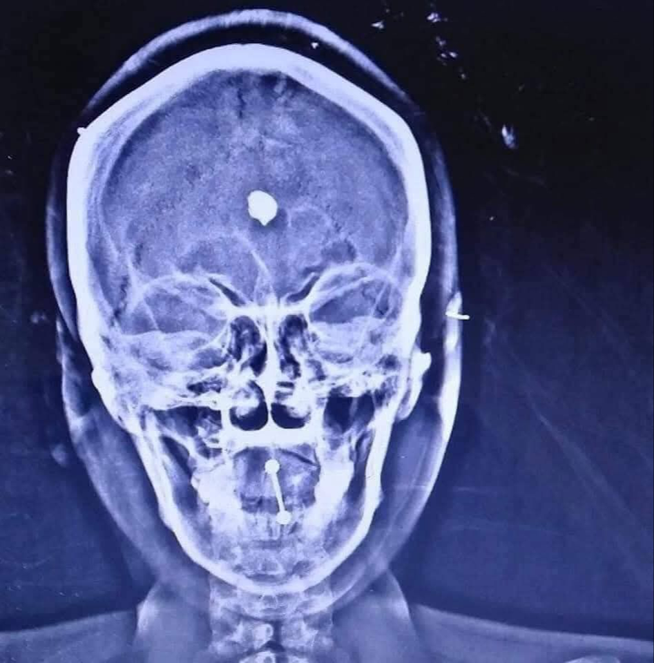 La víctima fue agredida con un martillo y un arma de fuego.