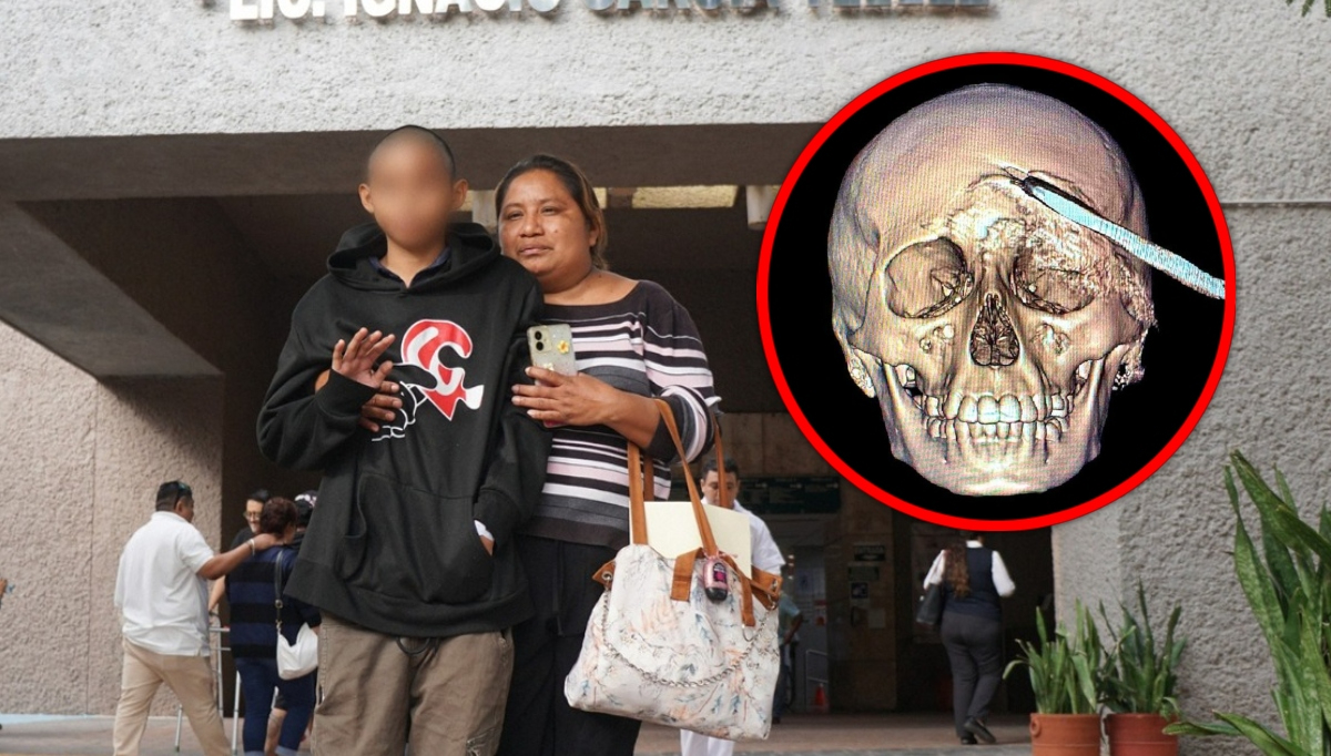 Médicos del IMSS Yucatán salvan la vida a un adolescente que tenía una coa incrustada en el cráneo