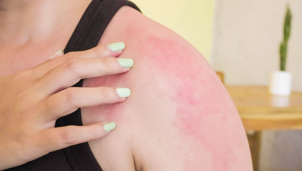 Puede causar enrojecimiento, hinchazón y, en casos severos, dermatitis de contacto Puede causar enrojecimiento, hinchazón y, en casos severos, dermatitis de contacto