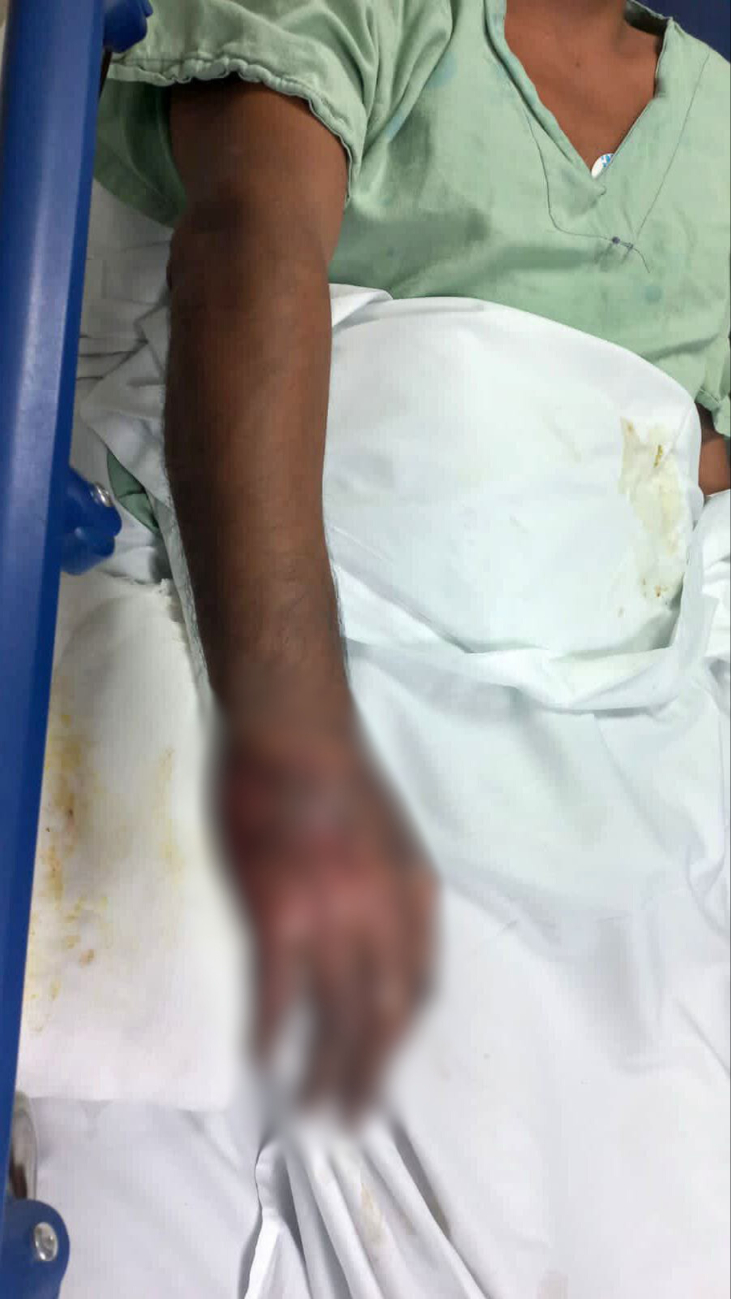 Don Tilo sufrió lesiones en su brazo y rostro; su esposa tiene quemaduras en el 80% de su cuerpo Don Tilo sufrió lesiones en su brazo y rostro; su esposa tiene quemaduras en el 80% de su cuerpo