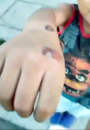 El infante mostró las marcas visibles del maltrato, principalmente causadas por la pareja sentimental de su mamá El infante mostró las marcas visibles del maltrato, principalmente causadas por la pareja sentimental de su mamá