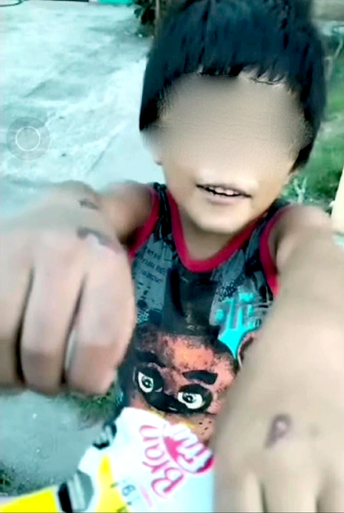 El menor contaba con marcas de quemaduras en sus brazos El menor contaba con marcas de quemaduras en sus brazos