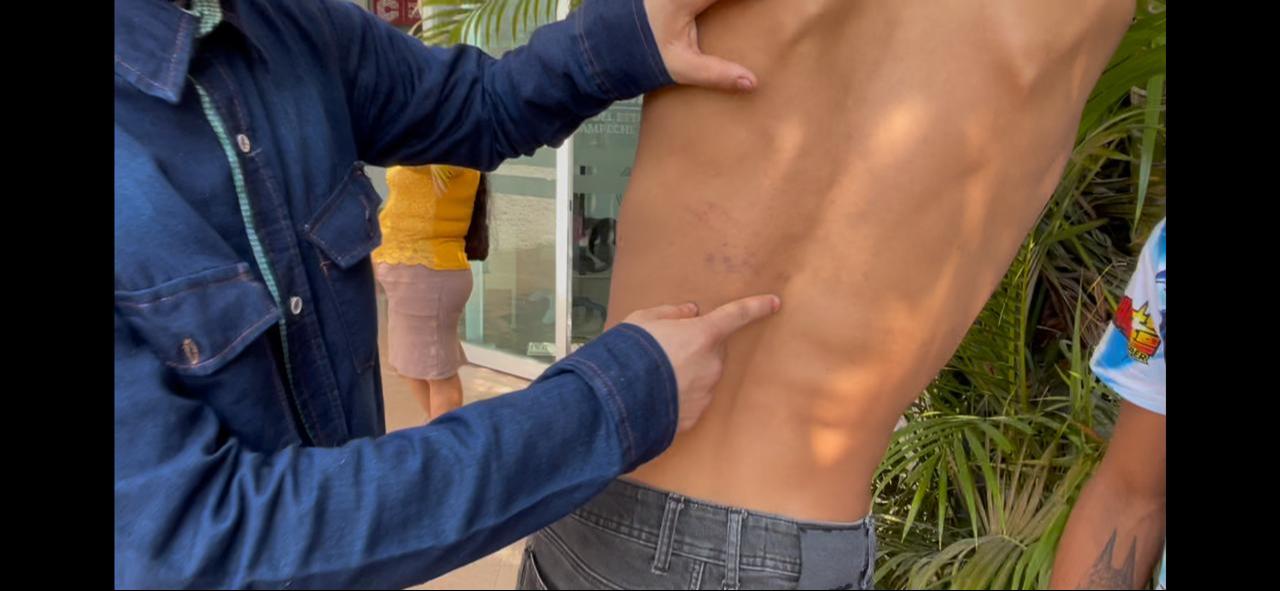 Una joven relató que fue golpeada con un palo por reírse, lo que le causó lesiones en la pierna y dificultad para sentarse Una joven relató que fue golpeada con un palo por reírse, lo que le causó lesiones en la pierna y dificultad para sentarse