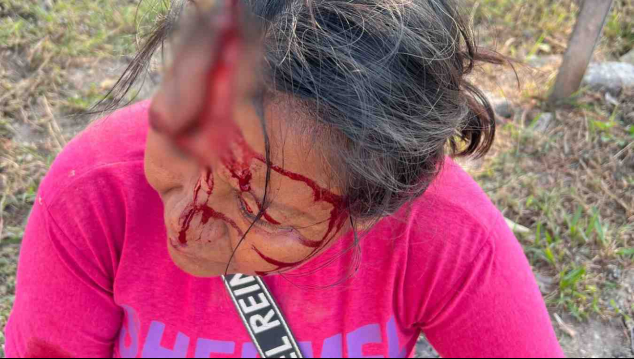 Mujer afectada por bache es auxiliada en Escárcega Mujer afectada por bache es auxiliada en Escárcega