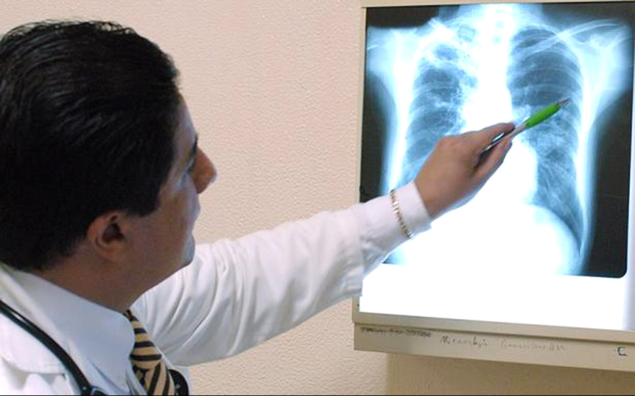 Pese a que se han registrado avances médicos, la bacteria sigue propagándose entre la población