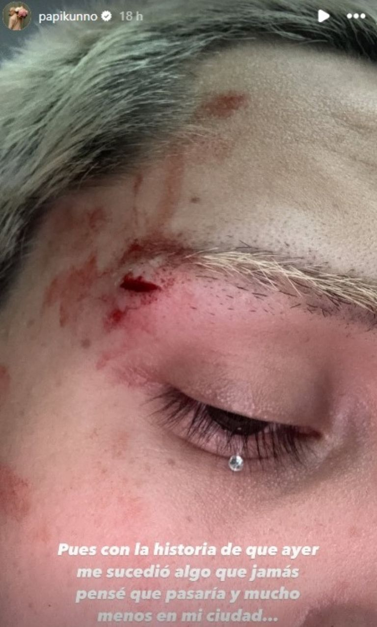 Así quedó el rostro de Kunno Así quedó el rostro de Kunno