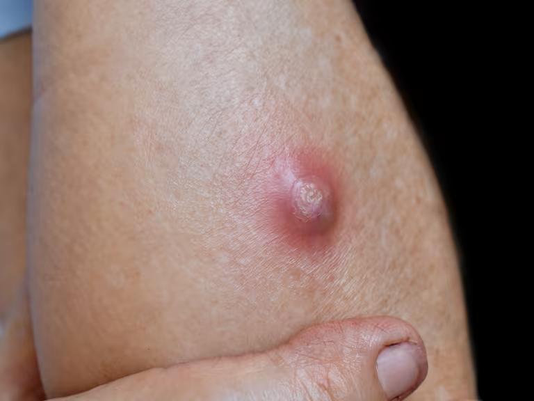 La larva parasitaria Cochliomyia hominivorax invade tejido vivo, causando miasis La larva parasitaria Cochliomyia hominivorax invade tejido vivo, causando miasis