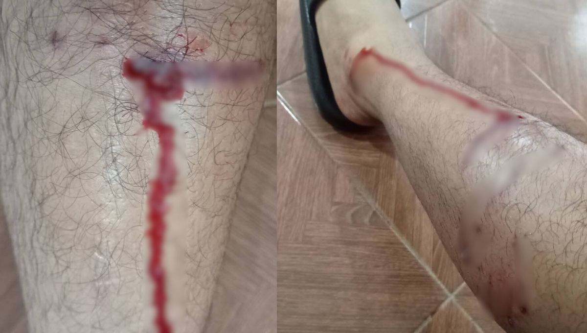 La víctima sufrió heridas en la pierna izquierda y fue atendida por sus familiares La víctima sufrió heridas en la pierna izquierda y fue atendida por sus familiares