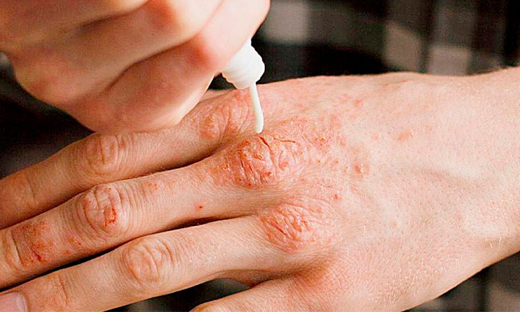 Los síntomas incluyen manchas claras en la piel, pérdida de sensibilidad y debilidad muscular Los síntomas incluyen manchas claras en la piel, pérdida de sensibilidad y debilidad muscular