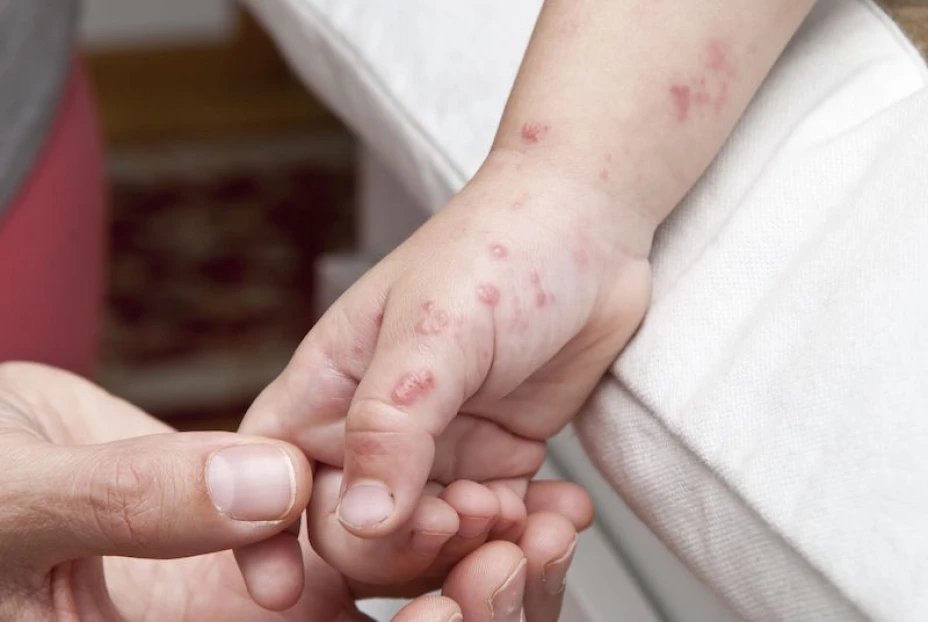 Educación y Salud se unen para prevenir el virus Coxsackie en alumnos