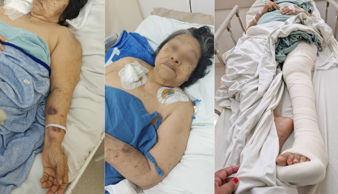 Negligencia médica en Campeche: solo tras denuncia operan a adulta mayor Negligencia médica en Campeche: solo tras denuncia operan a adulta mayor