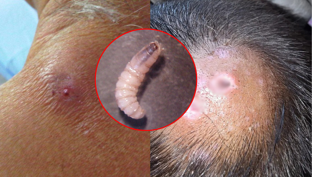 Miasis humana en Campeche: La enfermedad es causada por el gusano barrenador del ganado (Cochliomyia hominivorax).