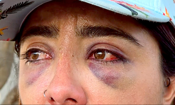La víctima exhibió que, supuestamente, fue golpeada durante su traslado a los separos; se confirmó que las lesiones no correspondían al accidente La víctima exhibió que, supuestamente, fue golpeada durante su traslado a los separos; se confirmó que las lesiones no correspondían al accidente