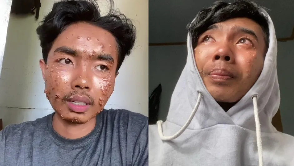 Joven se hace viral en las redes tras contagiarse de una infección por usar ropa de segunda mano Joven se hace viral en las redes tras contagiarse de una infección por usar ropa de segunda mano