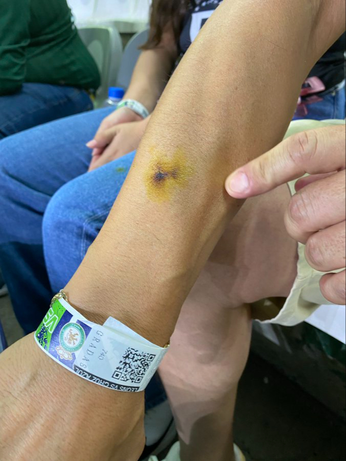 El aficionado y su brazo ligeramente afectado El aficionado y su brazo ligeramente afectado