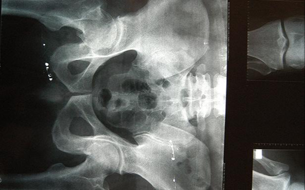 Las enfermedades como la osteopenia y osteoporosis, suelen manifestarse hasta que ocurre una fractura Las enfermedades como la osteopenia y osteoporosis, suelen manifestarse hasta que ocurre una fractura