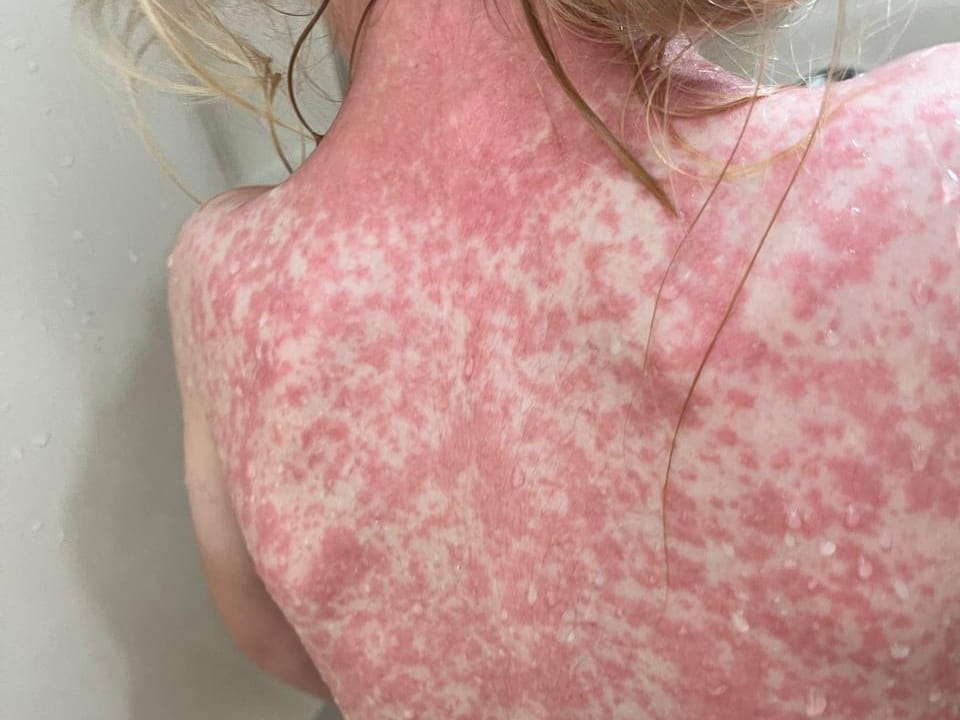 Los casos corresponden a dos hombres con síntomas compatibles con el virus Morbillivirus hominis. Los casos corresponden a dos hombres con síntomas compatibles con el virus Morbillivirus hominis.