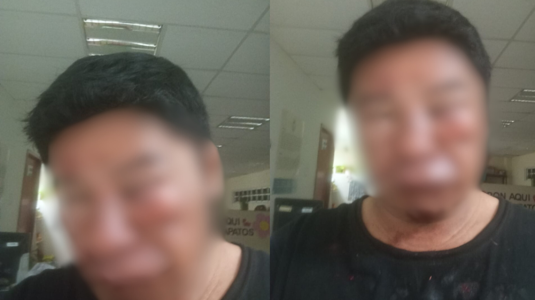 “Me arrojaron piedras en el rostro" Hombre denuncia intento de homicidio en Playa del Carmen “Me arrojaron piedras en el rostro" Hombre denuncia intento de homicidio en Playa del Carmen