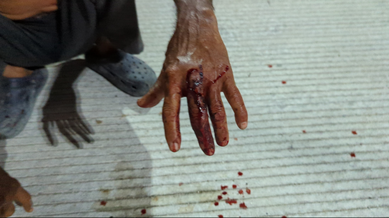 La mano izquierda del adulto mayor fue la que recibió la mordida. La mano izquierda del adulto mayor fue la que recibió la mordida.