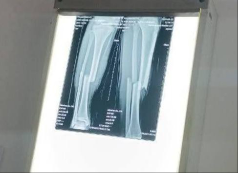La pierna del joven sufrió una inflamación después de que se le tomara unos rayo X, aparentemente el personal no tuvo cuidado La pierna del joven sufrió una inflamación después de que se le tomara unos rayo X, aparentemente el personal no tuvo cuidado