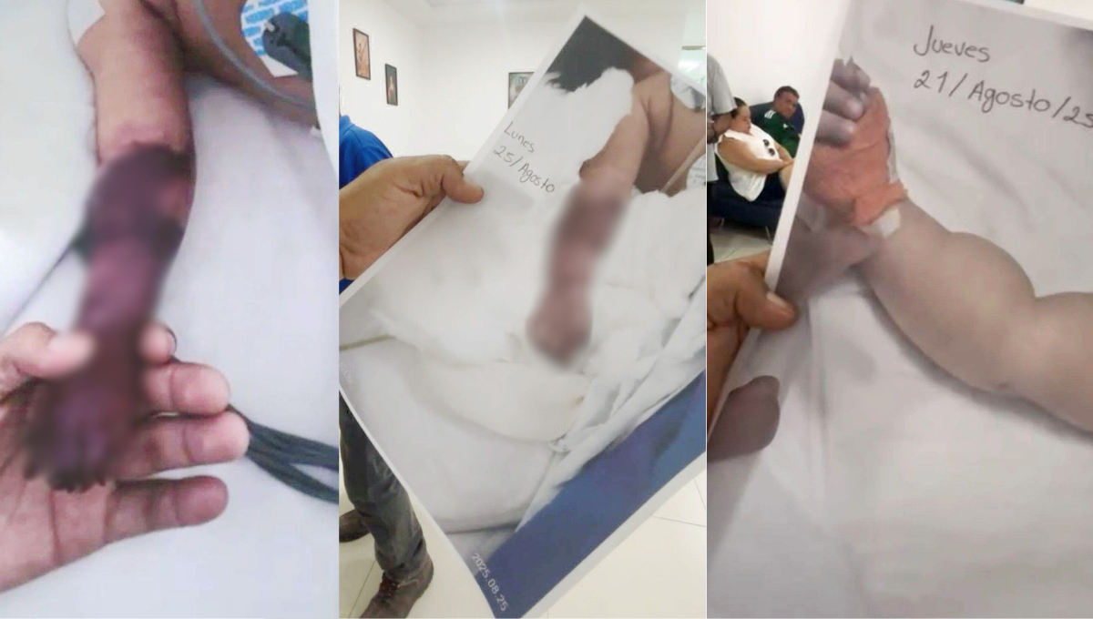 Indignación en Cancún: acusan a hospital de amputar brazo a bebé tras infección Indignación en Cancún: acusan a hospital de amputar brazo a bebé tras infección
