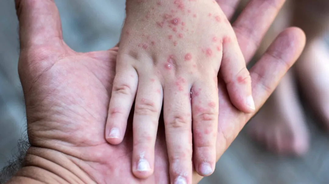 Península de Yucatán registra 13 casos probables de sarampión; uno ya fue confirmado en Yucatán