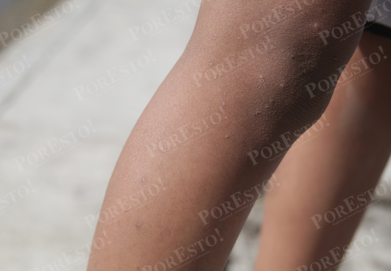 Debido a la contaminación de las cisternas, vecinos han reportado reacciones en su piel