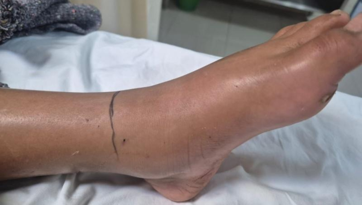 La menor fue trasladada a Mérida para su atención médica