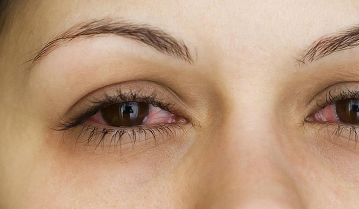 Esta infección se transmite a través de las secreciones de los ojos y de las vías respiratorias superiores.