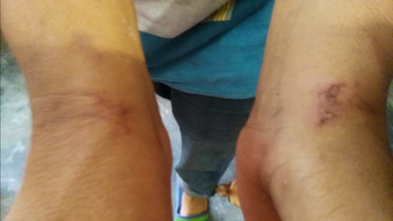 Los denunciantes muestras las lesiones presuntamente hechas por los policías Los denunciantes muestras las lesiones presuntamente hechas por los policías