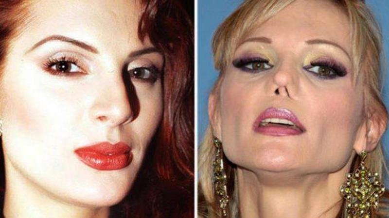 La cantante sufrió deformidades en la nariz que ha tenido que tratar La cantante sufrió deformidades en la nariz que ha tenido que tratar