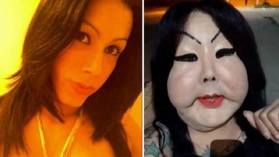 Una mujer transexual, identificada como Juju Oliveira, de 30 años, se encuentra con el rostro deformado luego de inyectarse silicona industrial Una mujer transexual, identificada como Juju Oliveira, de 30 años, se encuentra con el rostro deformado luego de inyectarse silicona industrial
