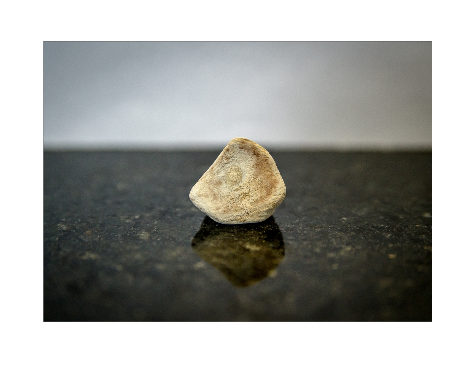 El padecimiento conocido como “piedras en los riñones” es muy común en el Estado