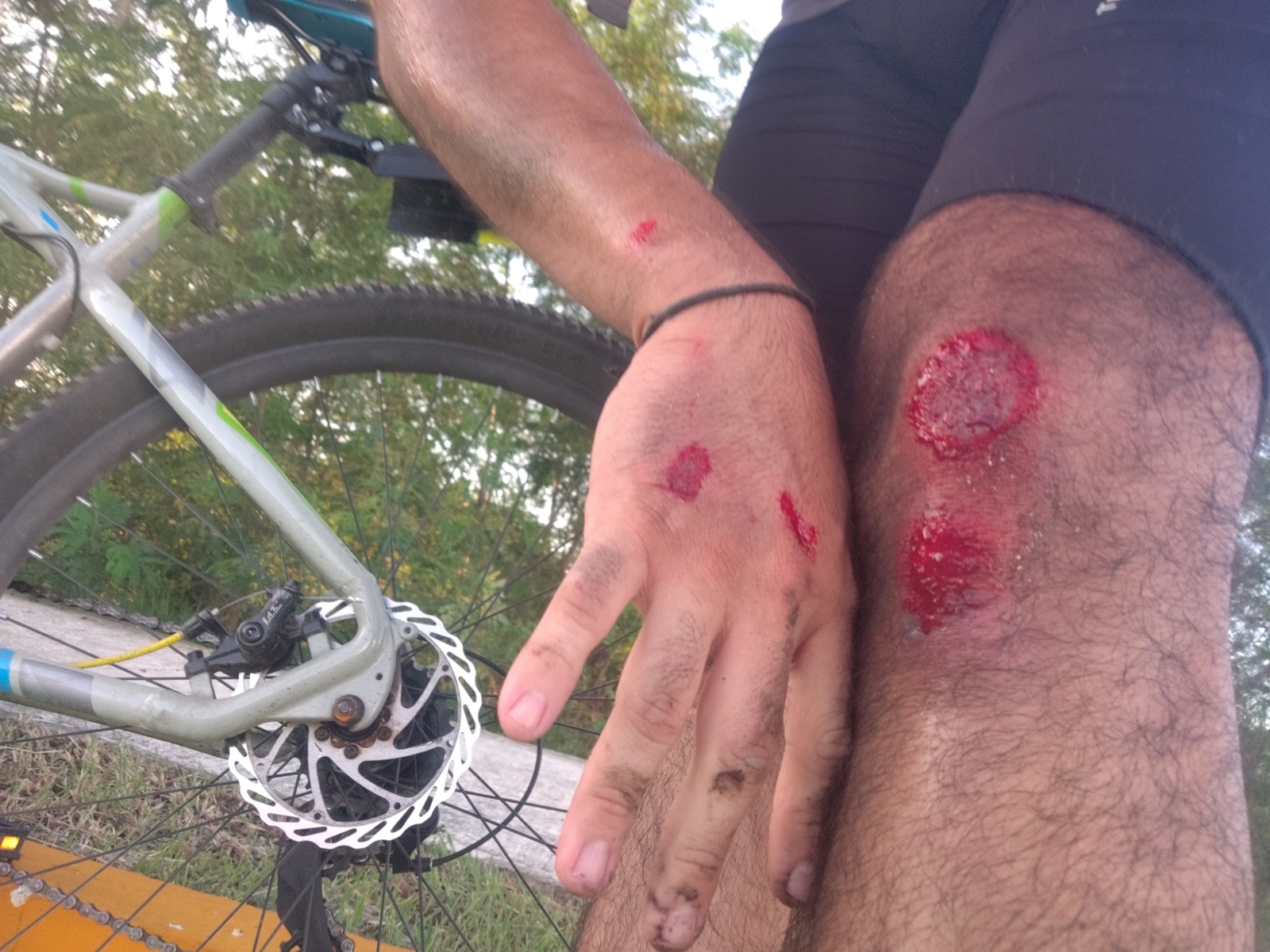 Joven yucateco termina lesionado tras ser derribado en su bicicleta por un corredor Joven yucateco termina lesionado tras ser derribado en su bicicleta por un corredor