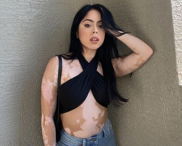El vitiligo es una enfermedad que afecta a 1 de cada 100 personas El vitiligo es una enfermedad que afecta a 1 de cada 100 personas