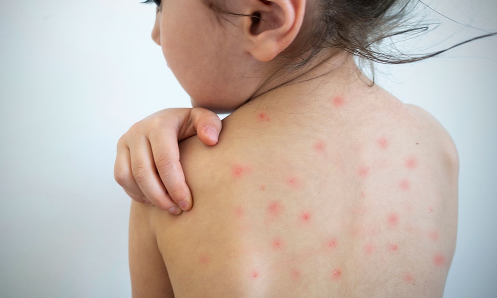 Quintana Roo: Descubre cómo prevenir el sarampión y la rubéola