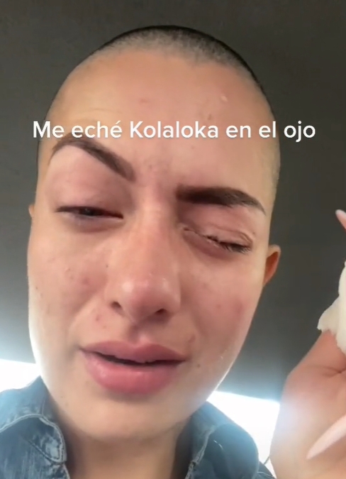 La joven muestra su ojos pegado con Kola loka
