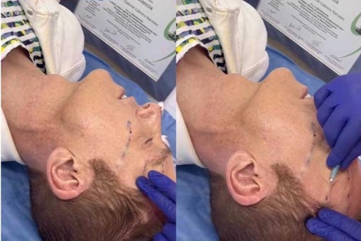 Daniel Bisogno se operó para verse más joven Daniel Bisogno se operó para verse más joven