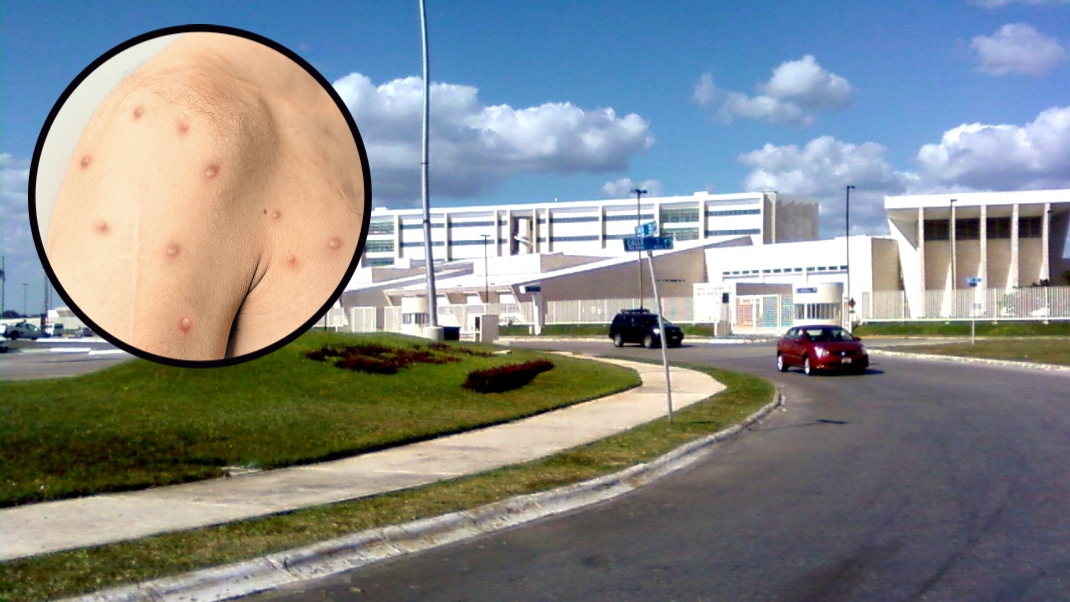 Muere paciente con viruela del mono en el Hospital de Alta Especialidad en Mérida