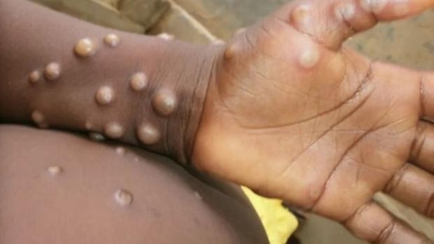 La viruela de mono es una enfermedad fuertemente contagiosa