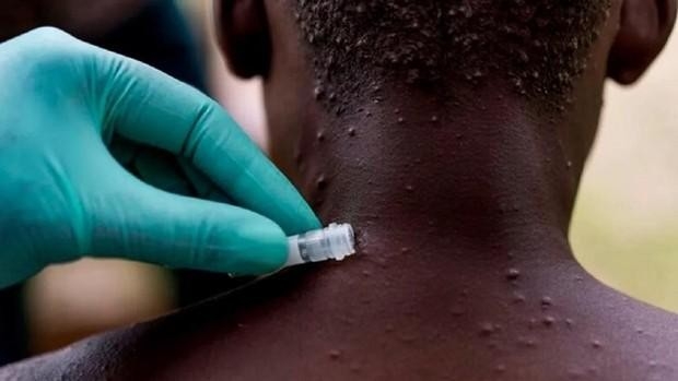 Viruela del mono: Qué es, cómo se transmite y lo que dicen las autoridades